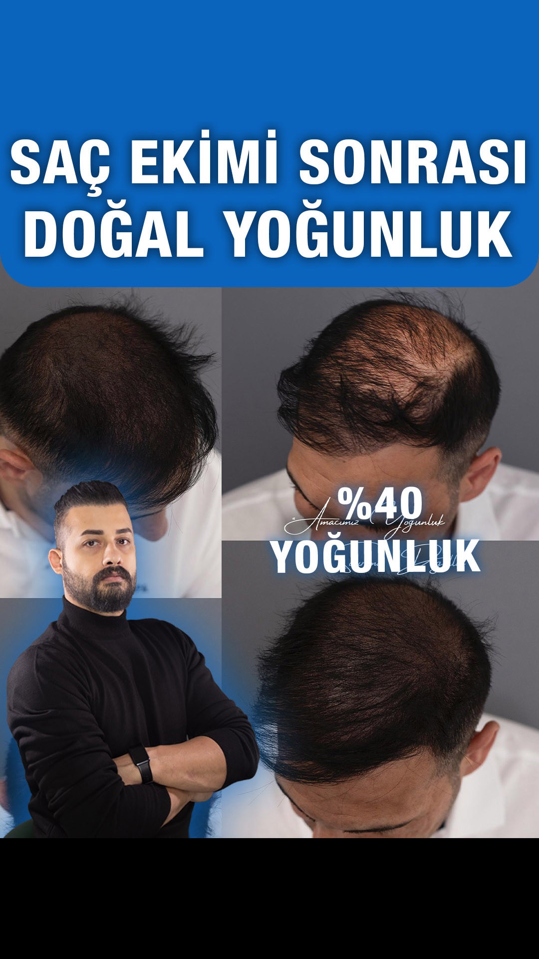 Saç ekimi sonrası tamamlayıcı görünüm — Semih Deniz’in Elazığ danışan arşivi