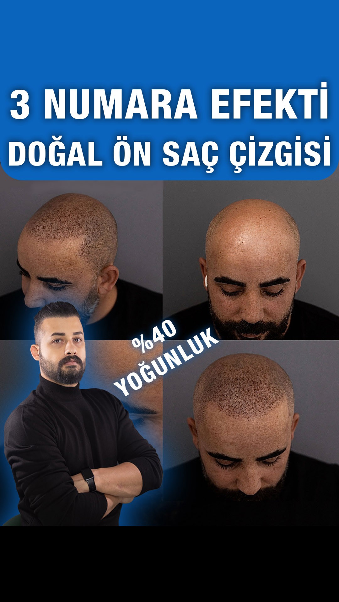 Ön saç çizgisi ve kısa tıraş — Semih Deniz’in Elazığ danışan arşivi