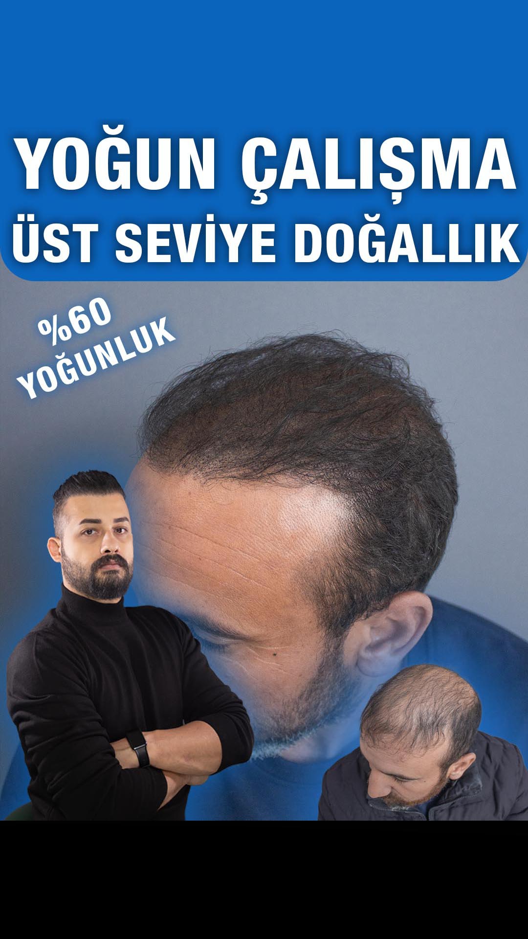 Mevcut saçla yoğunluk uyumu — Semih Deniz’in Elazığ danışan arşivi
