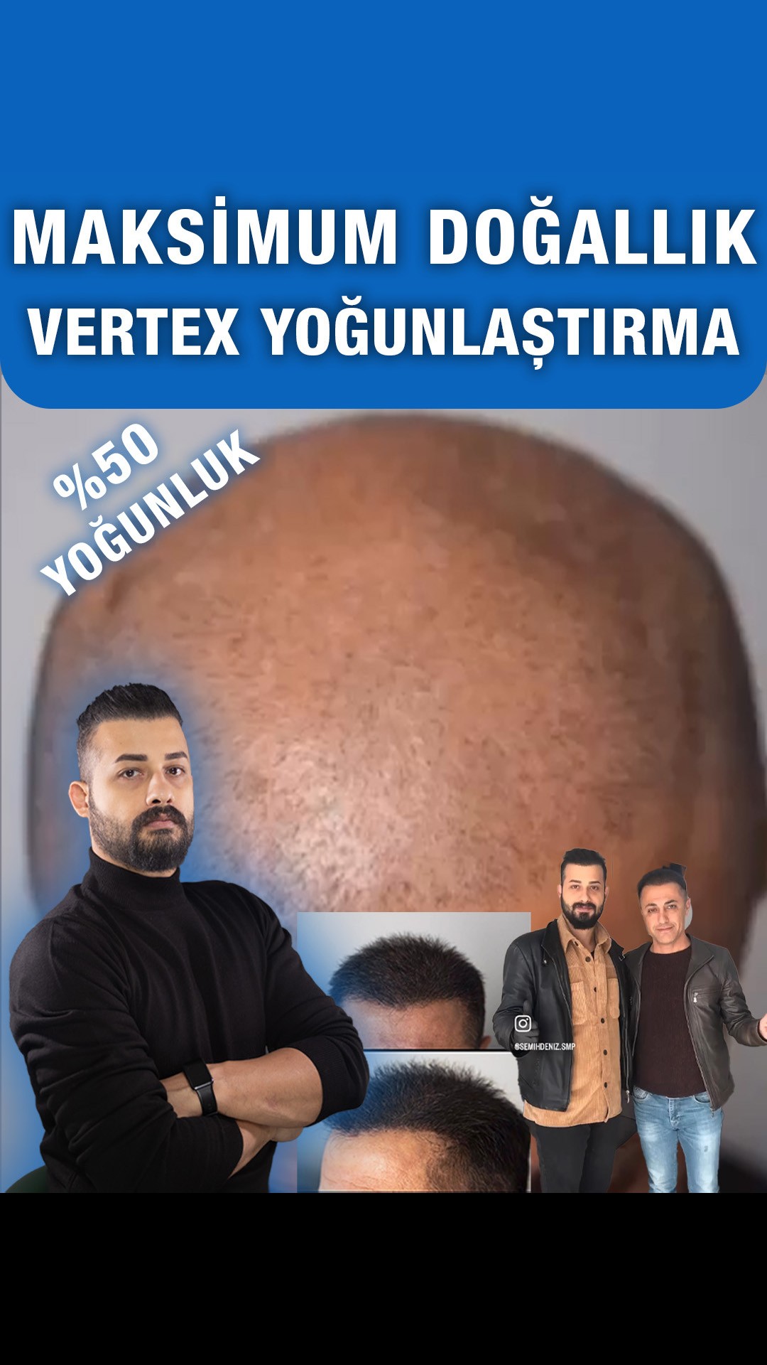 Tepe bölgesinde yoğunlaştırma görünümü — Semih Deniz’in Elazığ danışan arşivi