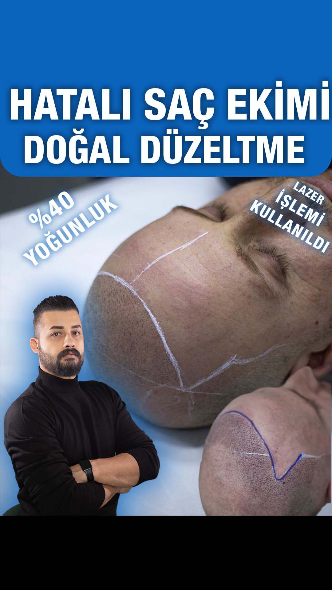 Saç ekimi sonrası yeniden değerlendirme — Semih Deniz’in Elazığ danışan arşivi