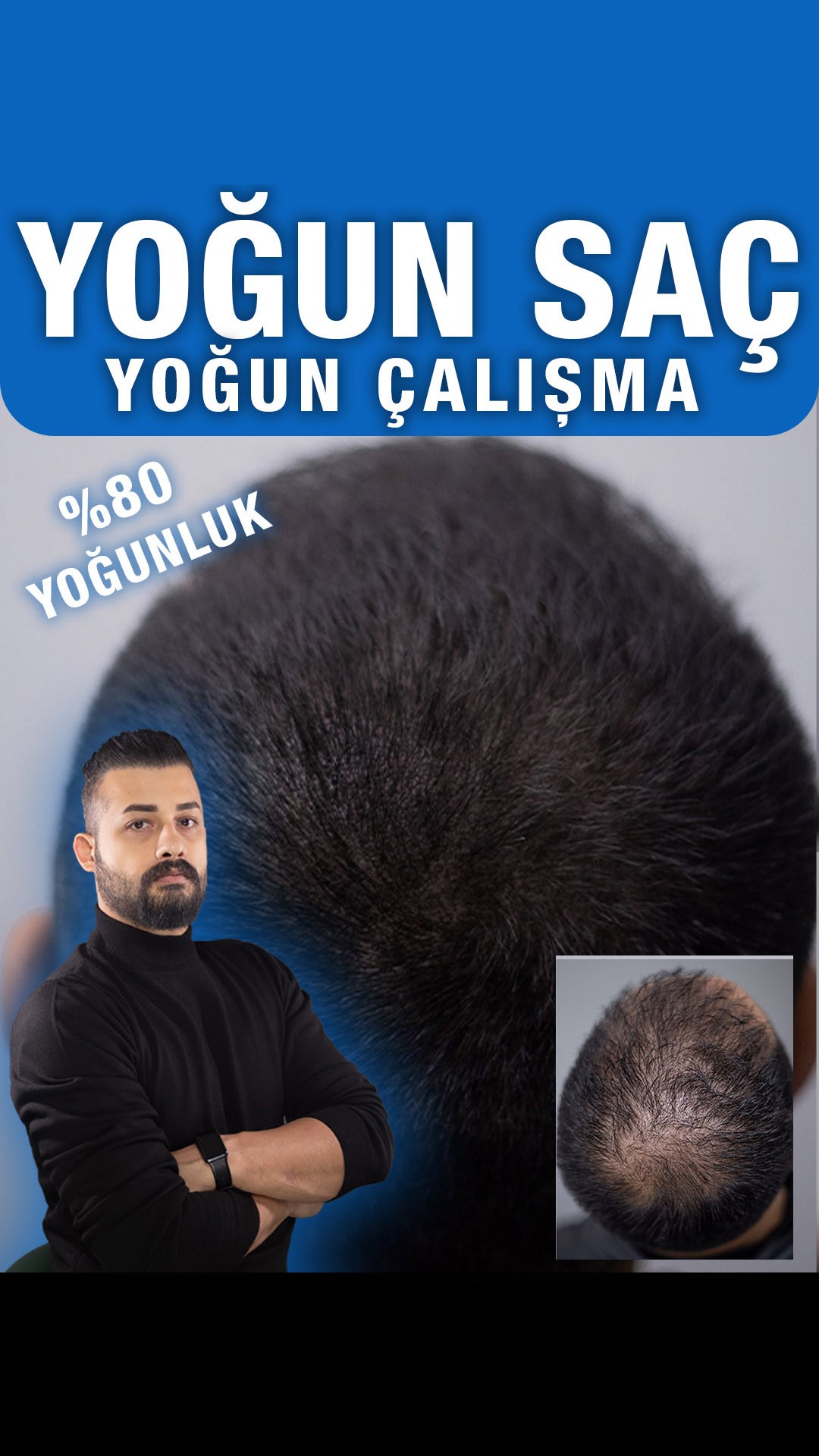 Yoğun saçta tamamlayıcı görünüm — Semih Deniz’in Şanlıurfa danışan arşivi